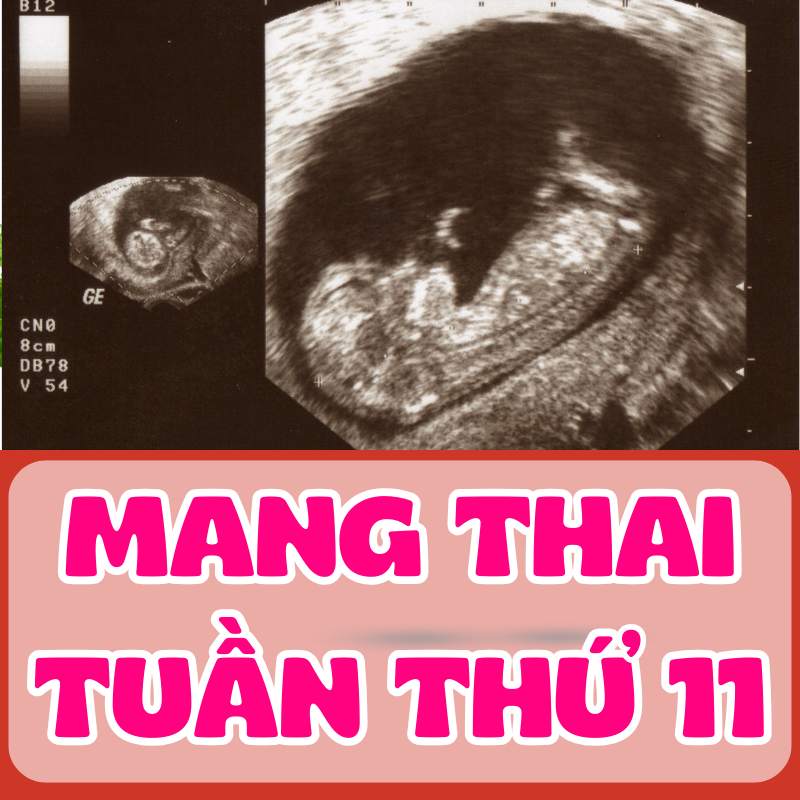 Siêu âm thai kỳ tuần thứ 11